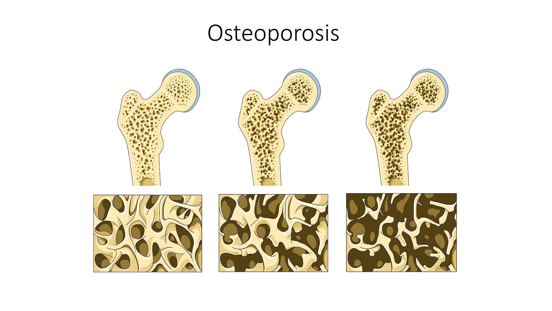 Imagem de referência de osteoporose, descrito nos dados abertos como doença que provoca o desgaste da densidade da estrutura óssea