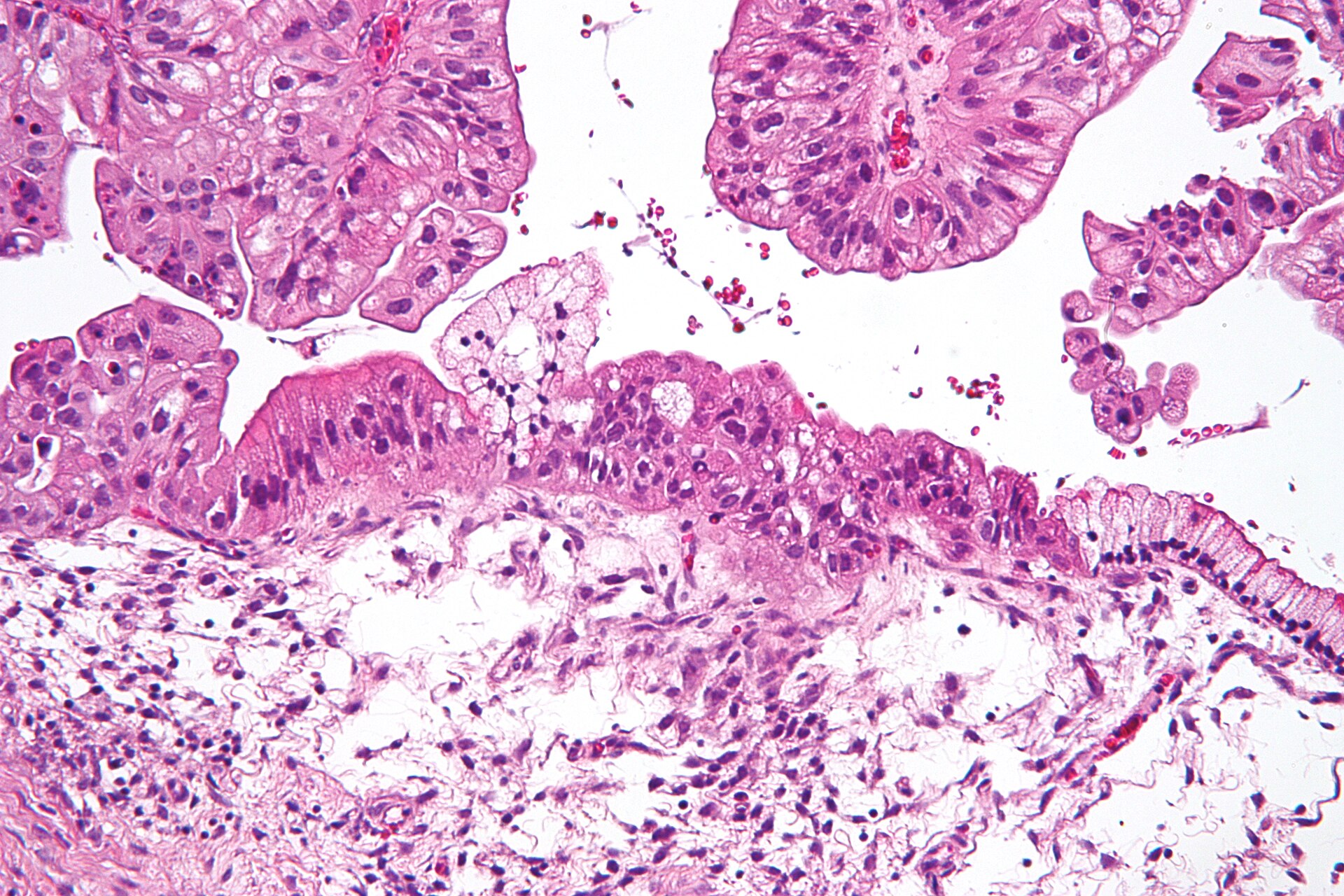 Imagem de referência de cancro do ovário, descrito nos dados abertos como tumor Maligno que surge nos Ovários