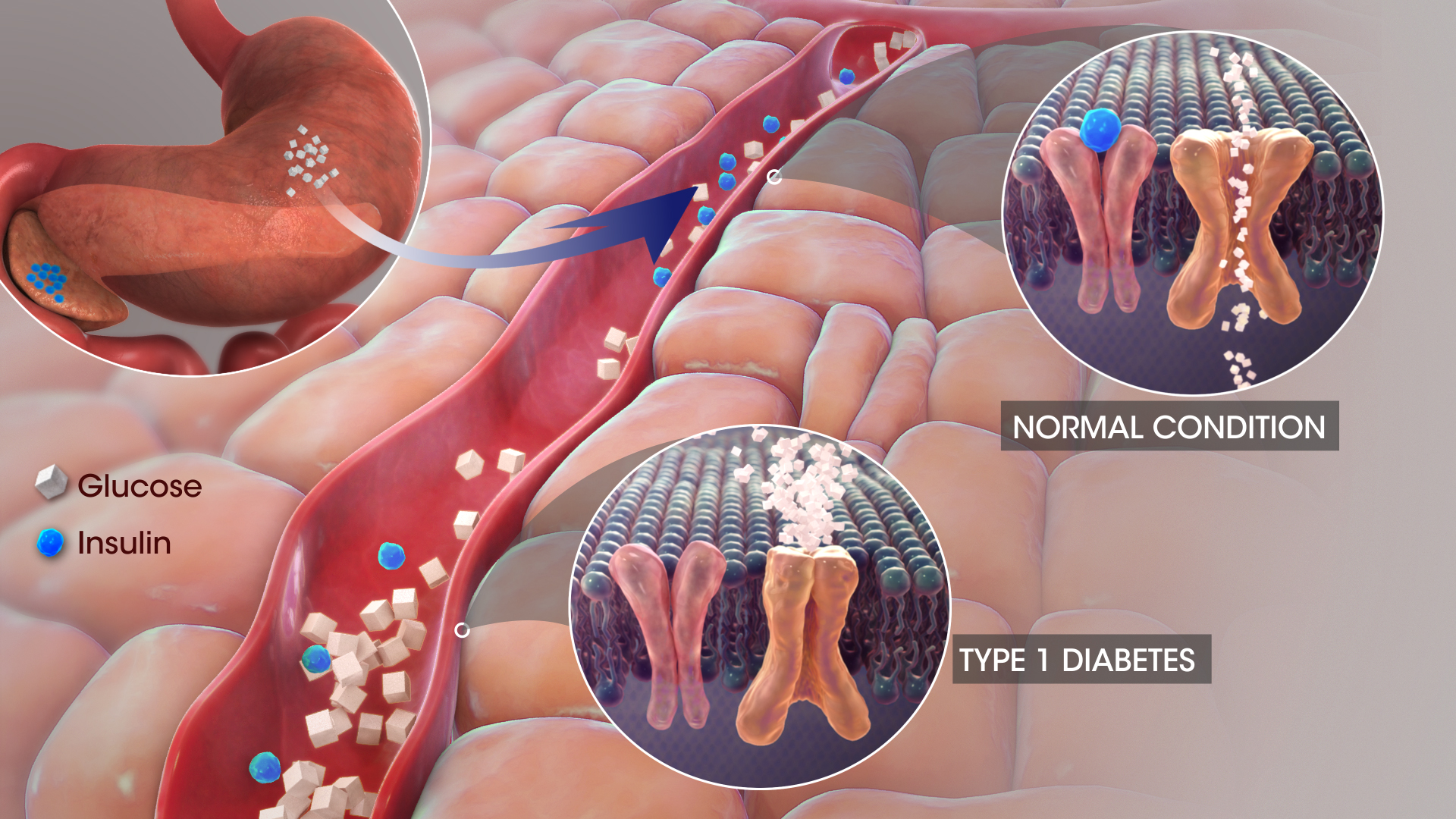 Imagem de referência de diabetes mellitus tipo 1, descrito nos dados abertos como tipo de diabetes causado pela destruição Autoimune das células Beta no Pâncreas