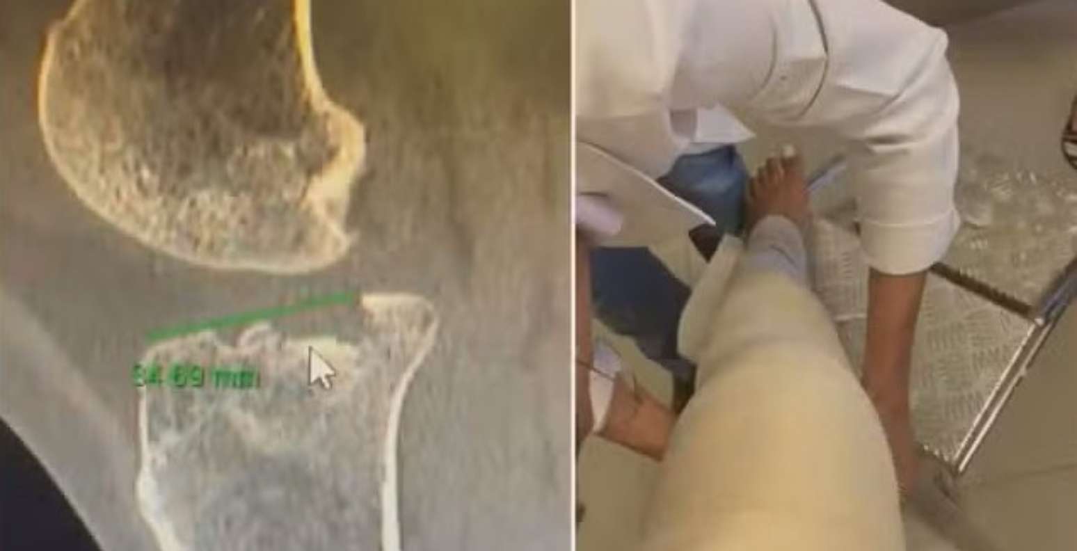 Homem pisou no joelho de uma das passageiras, causando uma fratura; ela vai passar por cirurgia