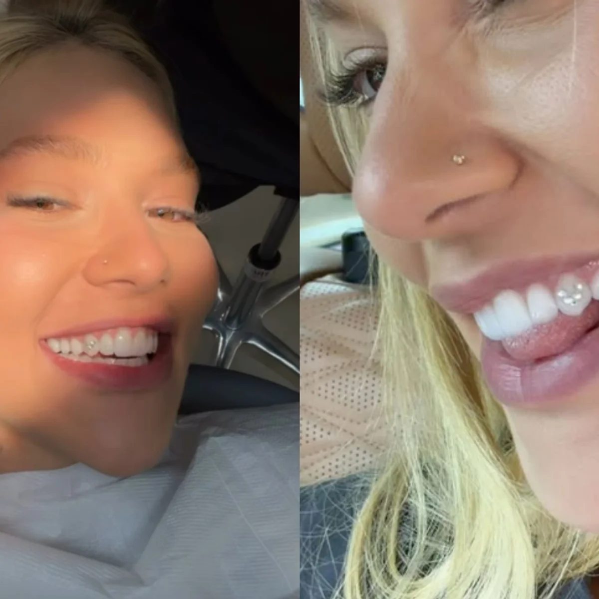 Joia nos dentes: dentista alerta sobre risco de tendência entre influencers